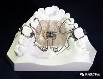 钟摆矫治器