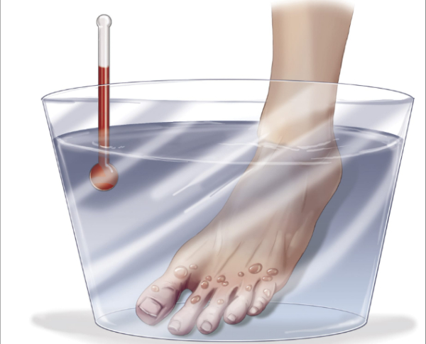 如果有人冻伤，如何提供帮助