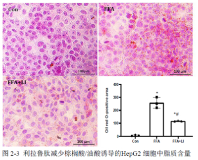 棕榈酸油酸诱导HepG2 细胞脂质沉积、铁死亡建立NAFLD模型