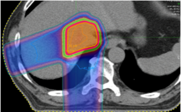 质子治疗有望“攻克”胶质瘤 日本在质子治疗脑胶质瘤有何优势？