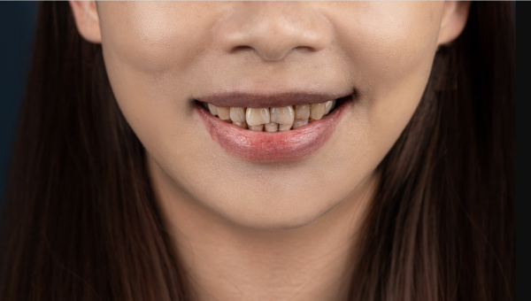 杭州六月微笑口腔贴面价格不贵，8颗只要8800元起医生技术好