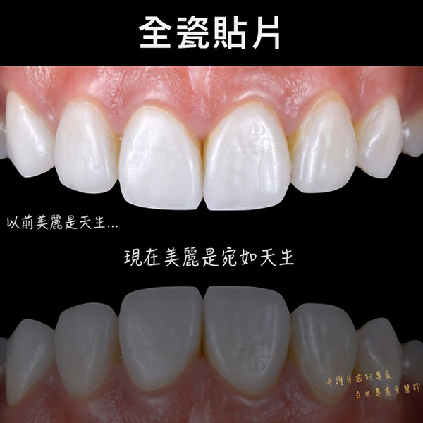 L六月微笑口腔 全瓷贴片｜陶瓷贴片｜美白贴片｜瓷牙贴片｜明星最爱