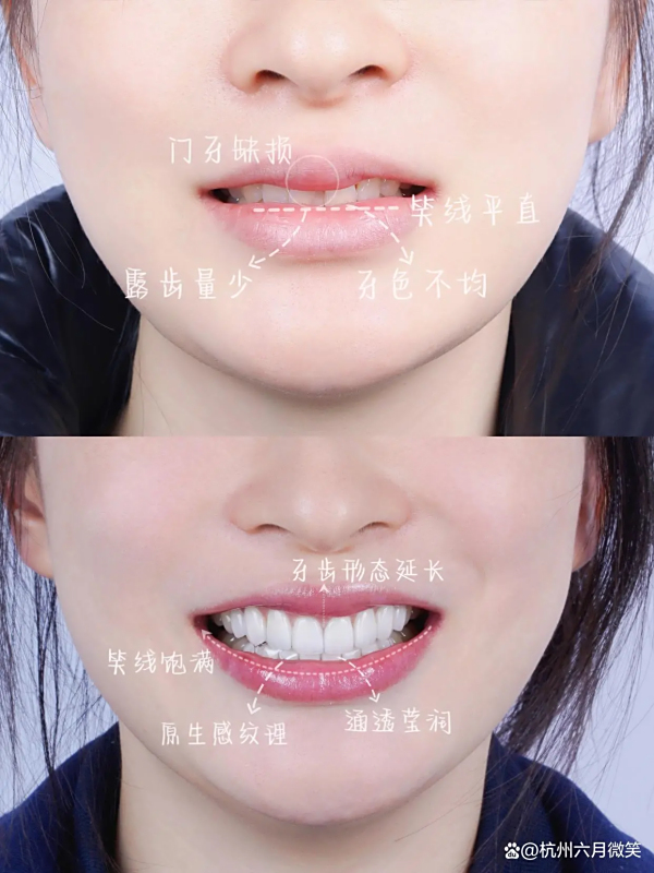 六月微笑口腔牙齿贴面最全的讲解！