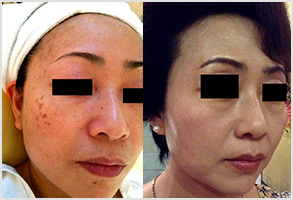 祛斑前后
