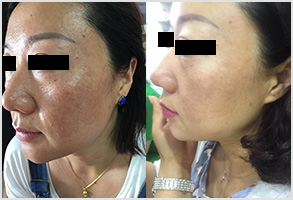 祛斑前后