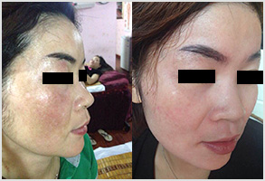 祛斑前后