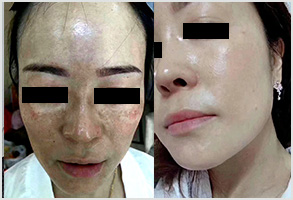 祛斑前后